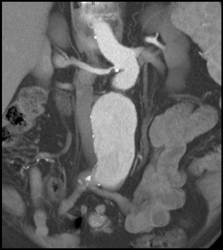 Aortic Aneurysm With Stenosis in Right Renal Artery - CTisus CT Scan