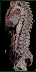 Aortic Aneurysm - CTisus CT Scan