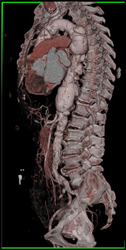 Aortic Aneurysm - CTisus CT Scan