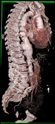 Aortic Aneurysm With Ulcerations - CTisus CT Scan