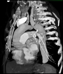 Post Repair of A Coarctation - CTisus CT Scan