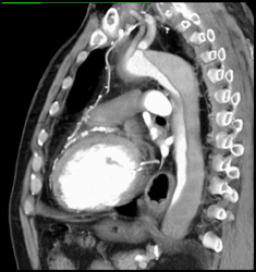 Aortic Dissection - CTisus CT Scan