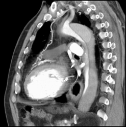 Aortic Dissection - CTisus CT Scan