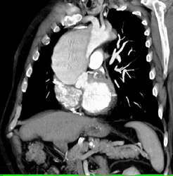 Aortic Dissection - CTisus CT Scan