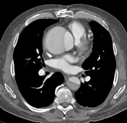 Type A Dissection - CTisus CT Scan