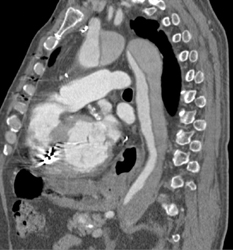 Type A Dissection - CTisus CT Scan