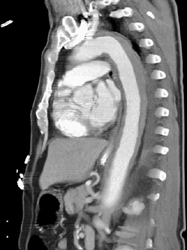 Type A Dissection - CTisus CT Scan