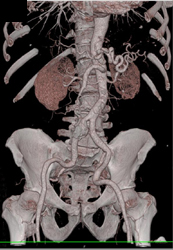 Iliac Artery Aneurysm - CTisus CT Scan