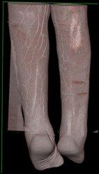 Cellulitis on A CTA - CTisus CT Scan