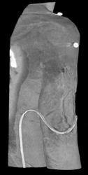 Ulceration of the Arm - CTisus CT Scan