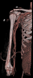 CTA of the Arm - CTisus CT Scan