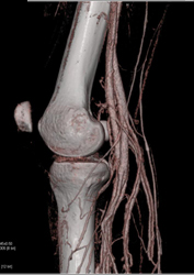 CTA of Popliteal Artery - CTisus CT Scan