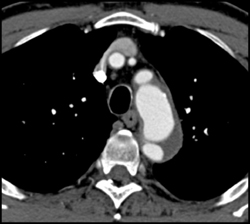 Aortic Dissection With Ulcer - CTisus CT Scan