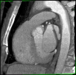 Normal Aorta - CTisus CT Scan