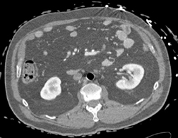 Aortic Balloon Pump Simulates Air in Aorta - CTisus CT Scan