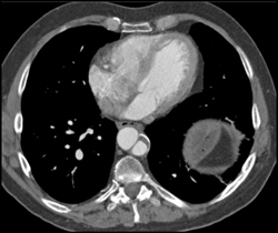 Clot in Aorta Plus Dissection - CTisus CT Scan