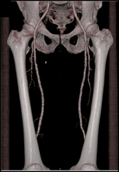 Diseased Superficial Femoral Arteries (SFAs) - CTisus CT Scan