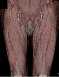 Diseased Superficial Femoral Arteries (SFAs) - CTisus CT Scan