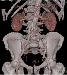 Iliac Aa Aneurysm - CTisus CT Scan