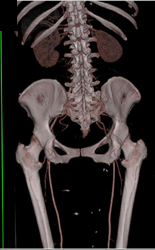 Occluded Right Iliac Aa - CTisus CT Scan