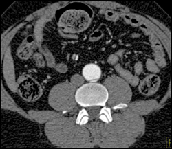 Aortic Dissection - CTisus CT Scan