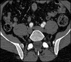 Aortic Dissection - CTisus CT Scan