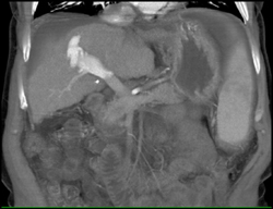 Av Fistulae in Liver - CTisus CT Scan