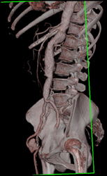 Femoral Aa Pseudoaneurysm - CTisus CT Scan