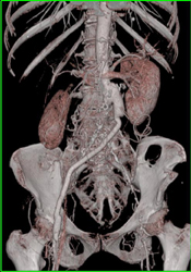 Clotted Left Limb of Graft - CTisus CT Scan