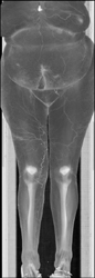 Diseased Superficial Femoral Arteries (SFAs) of Runoffs - CTisus CT Scan