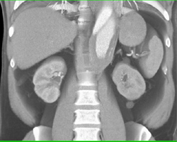 Diseased Aorta Involves Left Renal Artery - CTisus CT Scan