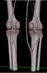 Occluded Right Superficial Femoral Artery (SFA) With Graft. Diseased Left SFA Also Seen - CTisus CT Scan