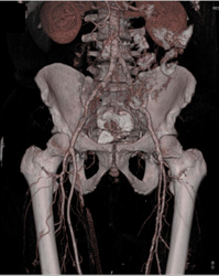 Diseased Iliac Aas - CTisus CT Scan