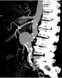 Focal Abdominal Aortic Aneurysm (AAA) - CTisus CT Scan