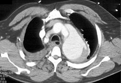 Type A Dissection - CTisus CT Scan