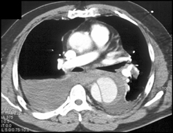 Type A Dissection - CTisus CT Scan