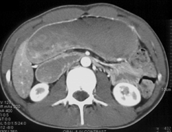 Superior Mesenteric Artery (SMA) Syndrome - CTisus CT Scan