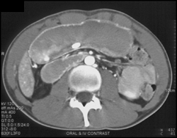 Superior Mesenteric Artery (SMA) Syndrome - CTisus CT Scan