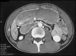 Superior Mesenteric Artery (SMA) Syndrome - CTisus CT Scan