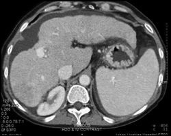 Cirrhosis With Arteriovenous (AV) Fistulae - CTisus CT Scan