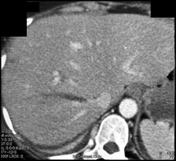 Liver Laceration Involves the Hepatic Veins - CTisus CT Scan