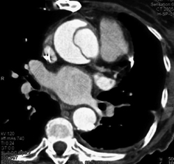 Type A Dissection - CTisus CT Scan