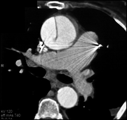 Type A Dissection - CTisus CT Scan