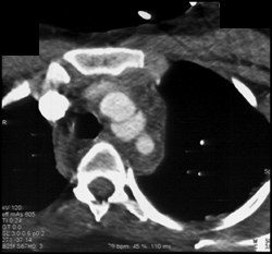 Traumatic Aortic Dissection - CTisus CT Scan