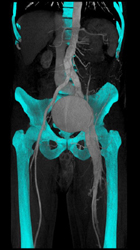 Vascular Bone Removal Algorithm Demo - CTisus CT Scan