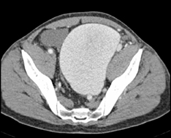 Arteriovenous (AV) Fistulae and Pelvic Venous Varix - CTisus CT Scan