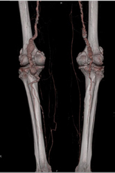 Popliteal Aa Aneurysms - CTisus CT Scan