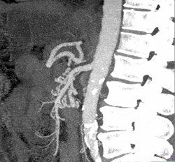 Median Arcurate Ligament Syndrome - CTisus CT Scan