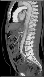 Type B Dissection - CTisus CT Scan