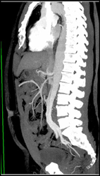 Type B Dissection - CTisus CT Scan